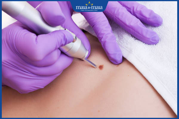 Trị hạt cơm bằng Plasma: Ưu nhược điểm và lưu ý khi điều trị 4 thực hiện đốt hạt cơm