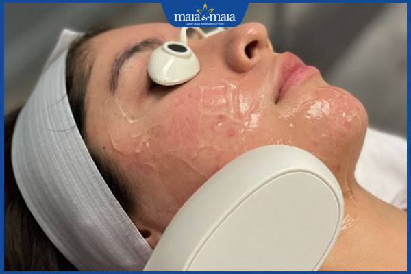 thực hiện dùng ánh sáng elight trị mụn