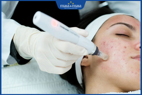 Phi kim trị mụn có tốt không? Ưu và nhược điểm khi thực hiện 7 thực hiện phi kim trị mụn