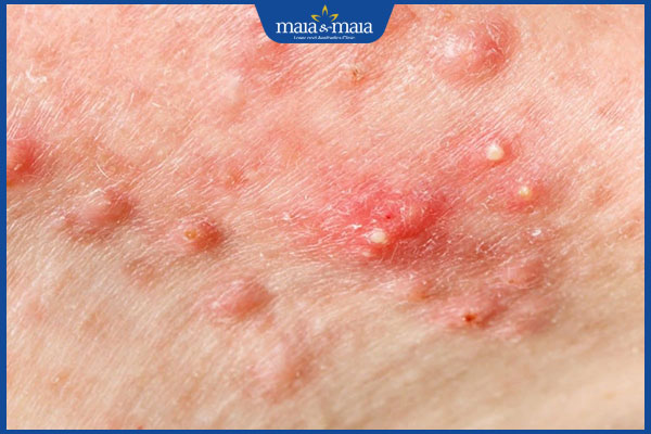 Dùng BHA bao lâu thì đẩy mụn? Cách xử lý khi bị kích ứng 2 tình trạng đẩy mụn khi dùng bha