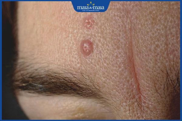 Mụn HIV với mụn thông thường có điểm gì khác nhau? 2 tổn thương da cho hiv