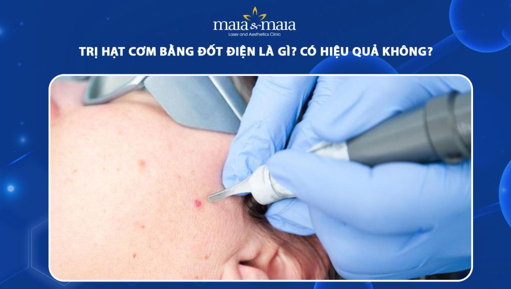 trị hạt cơm bằng đốt điện
