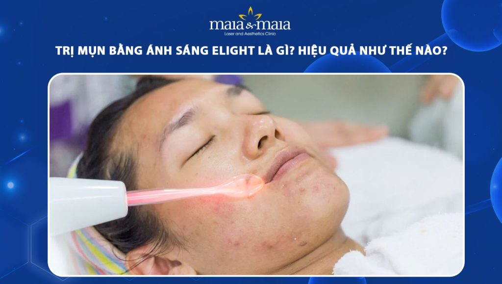 trị mụn bằng ánh sáng elight