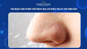 trị mụn cám ở mũi