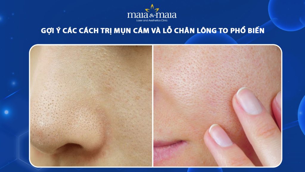 trị mụn cám và lỗ chân lông to