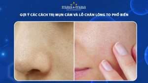 trị mụn cám và lỗ chân lông to