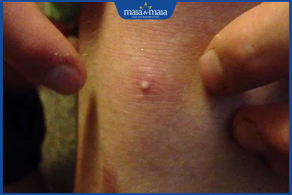 Mụn nang ở đầu gối có nguy hiểm không? Điều trị như thế nào? 2 triệu chứng mụn nhọt ở đầu gối