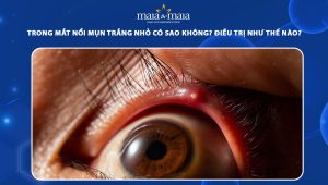 trong mắt nổi mụn trắng nhỏ