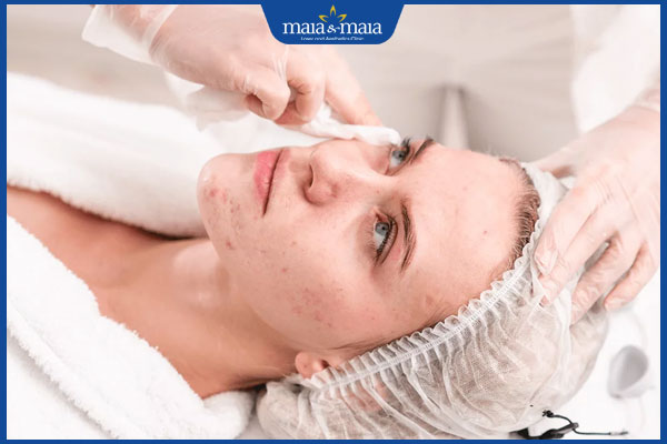 Hướng dẫn cách nặn mụn đầu đen ở mũi an toàn cho da 4 vệ sinh da sau nặn mụn