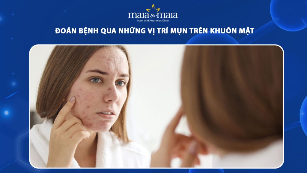 Đoán bệnh qua những vị trí mụn trên khuôn mặt 1 vị trí mụn trên khuôn mặt