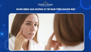 vị trí mụn trên khuôn mặt