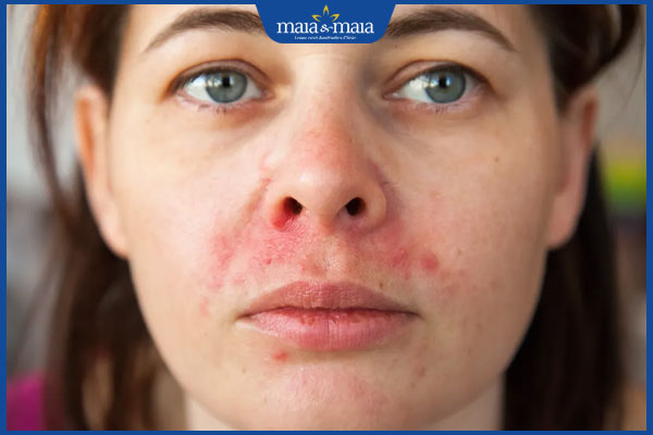 Nặn mụn xong bị lên mụn đầu trắng do đâu? Cách xử lý phù hợp 2 viêm da tiết bã