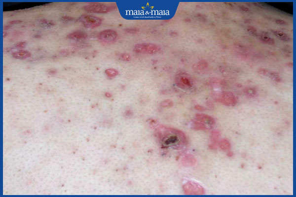 Có nên nặn mụn lưng không? Cách xử lý mụn lưng hiệu quả 2 viêm nhiễm sau khi tự nặn mụn lưng