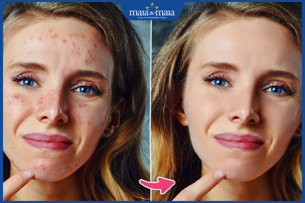 10 app xóa mụn miễn phí chỉnh sửa ảnh siêu hiệu quả hiện nay 2 xu hướng sử dụng app xóa mụn