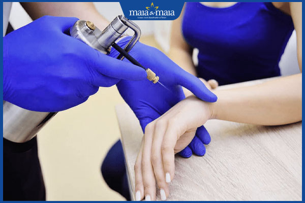 Tay nổi mụn cứng do đâu? Gợi ý 4 cách khắc phục hiệu quả 5 áp lạnh mụn cóc ở tay