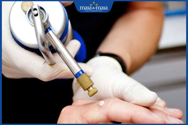 áp lạnh trị mụn cóc