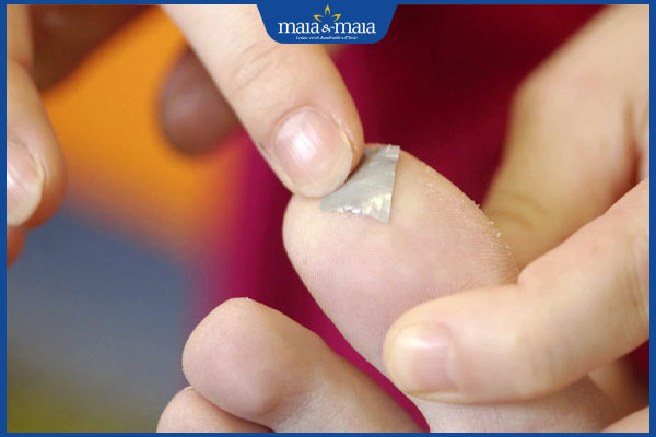 băng keo trị mụn cóc