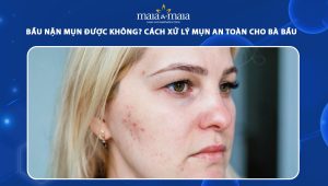 bầu nặn mụn được không