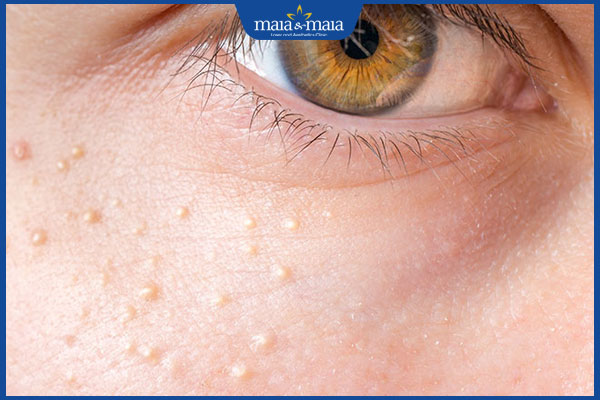 bị mụn đá trên mặt