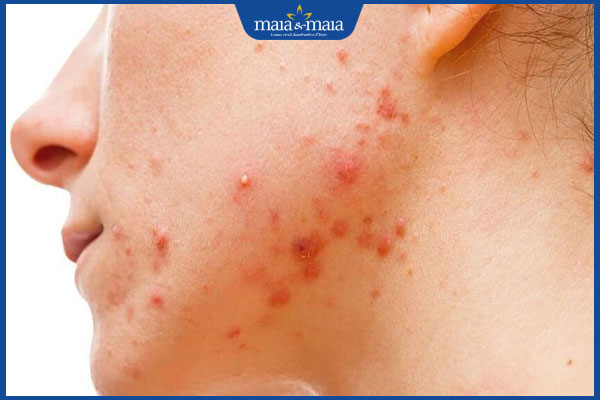 Tới tháng có nên nặn mụn không? Cách chăm sóc da ngày đèn đỏ 2 bị mụn khi tới tháng