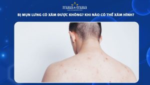 bị mụn lưng có xăm được không
