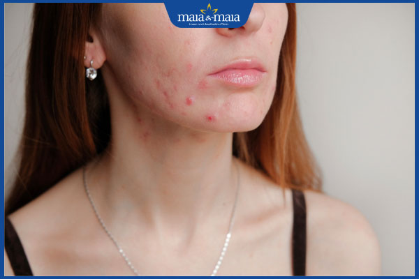 bị nổi mụn vào mùa đông