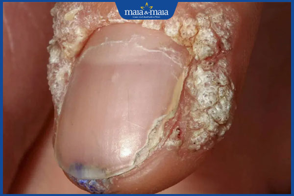 biến chứng mụn ké ở tay