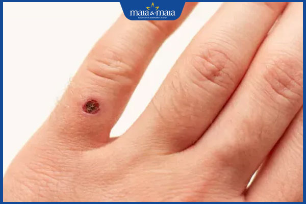 Trị mụn cóc bằng nitơ lỏng: Ưu điểm và quy trình thực hiện 4 biểu hiện bình thường sau khi xịt nitơ lỏng