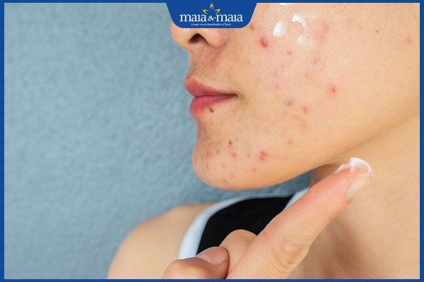 Nặn mụn xong bôi Klenzit MS được không? Lưu ý khi sử dụng 3 bôi kem lên da mụn