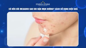 bôi Megaduo sau khi nặn mụn