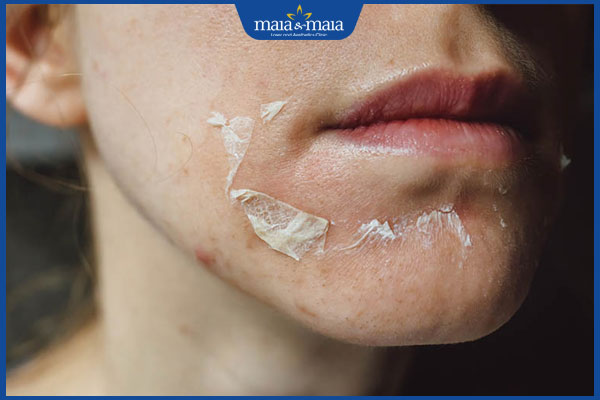 bong tróc sau peel da