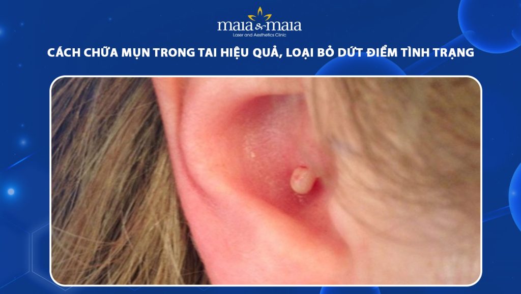 Cách chữa mụn trong tai hiệu quả dứt điểm và an toàn nhất 1 cách chữa mụn trong tai
