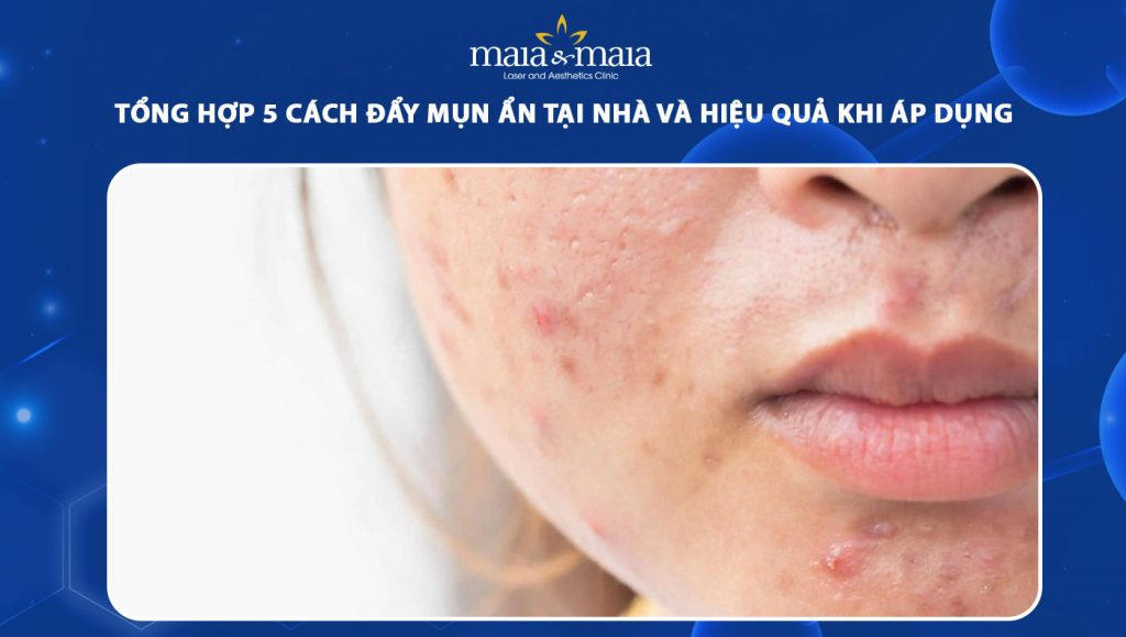 cách đẩy mụn ẩn