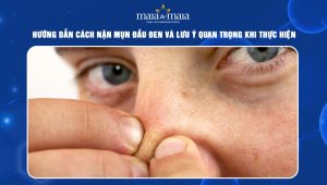 cách nặn mụn đầu đen