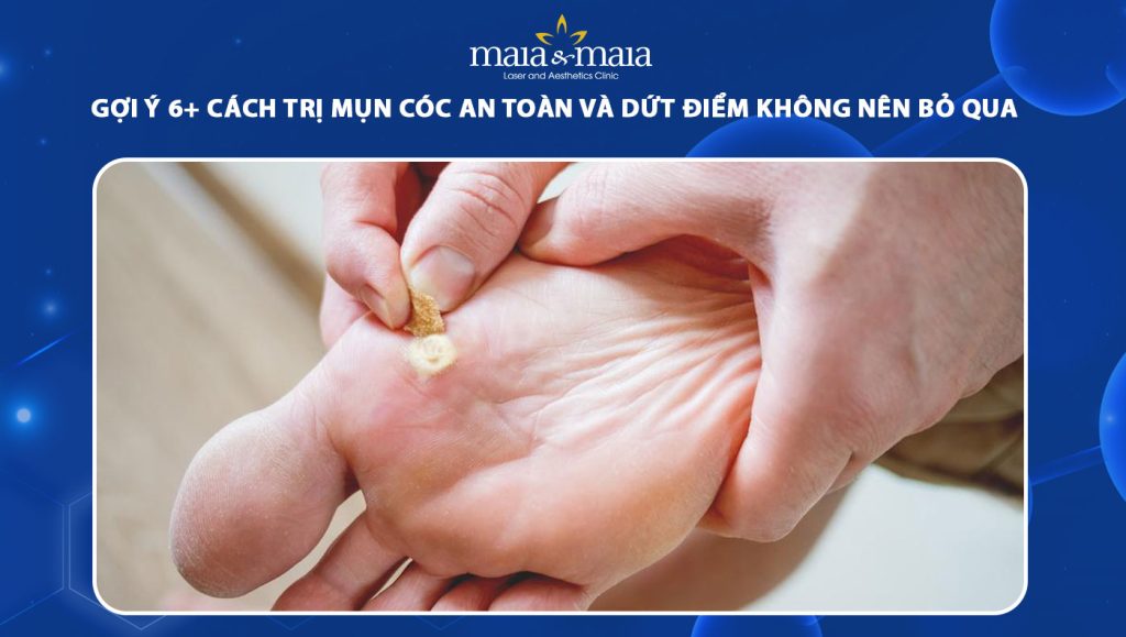 cách trị mụn cóc