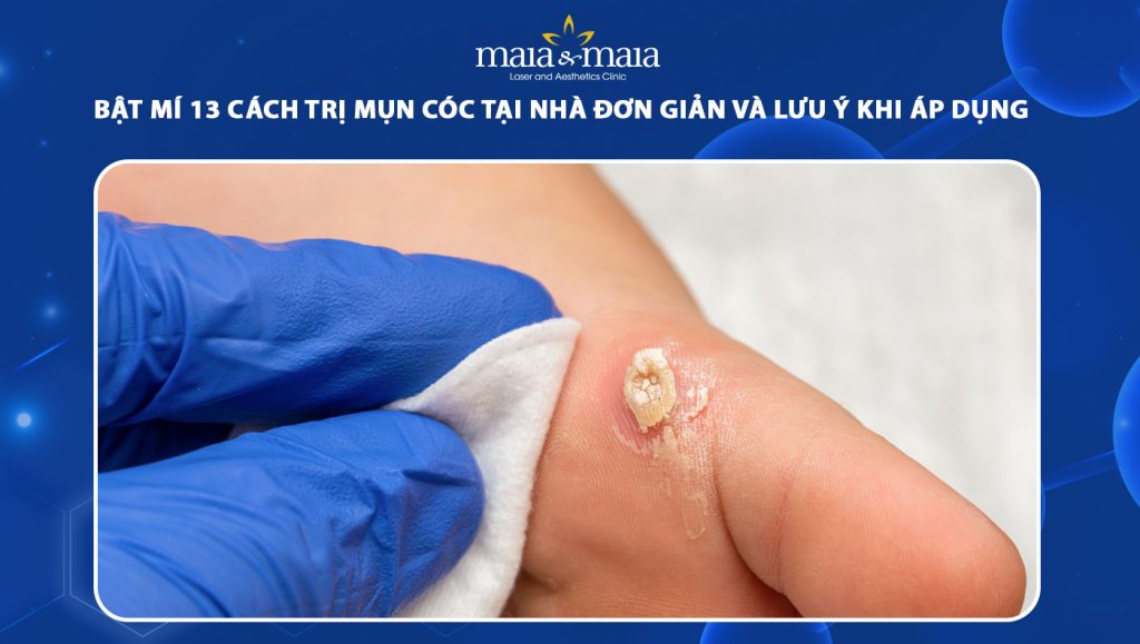 cách trị mụn cóc tại nhà