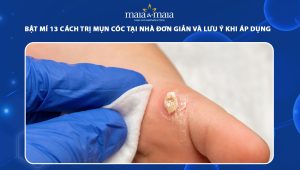 cách trị mụn cóc tại nhà