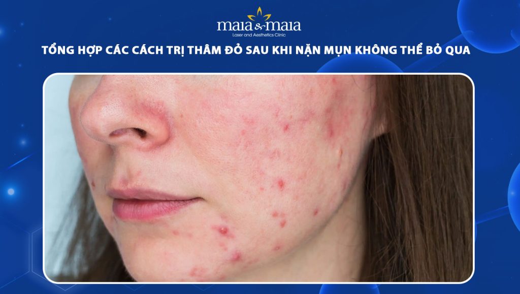 cách trị thâm đỏ sau khi nặn mụn
