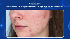 cách trị thâm đỏ sau khi nặn mụn
