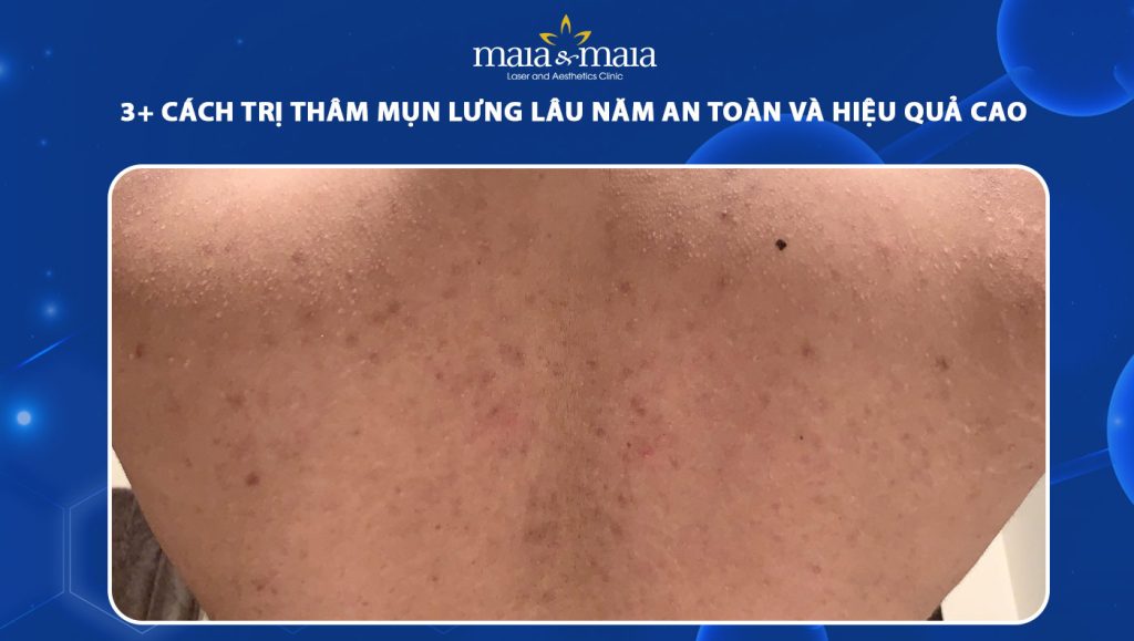 cách trị thâm mụn lưng lâu năm