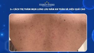 cách trị thâm mụn lưng lâu năm