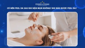 có nên peel da sau khi nặn mụn không