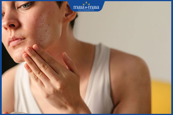 da mụn dùng kem dưỡng ẩm