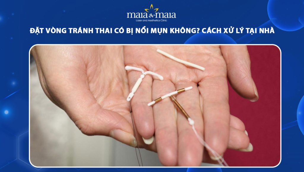 đặt vòng tránh thai có bị nổi mụn không