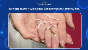 đặt vòng tránh thai có bị nổi mụn không
