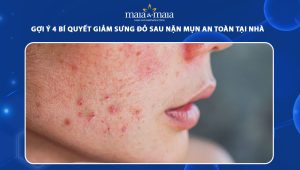 giảm sưng đỏ sau nặn mụn