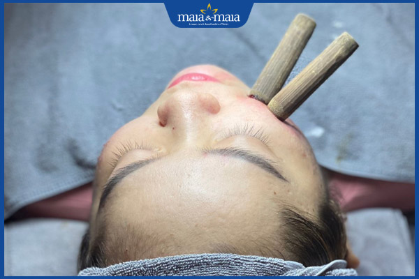 hút mụn ống tre