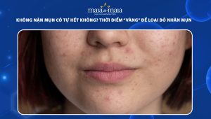 không nặn mụn có tự hết không