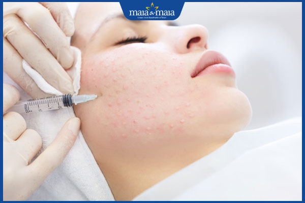Tiêm meso trị mụn có đau không? Hiệu quả trong bao lâu? 2 kỹ thuật tiêm meso trị mụn
