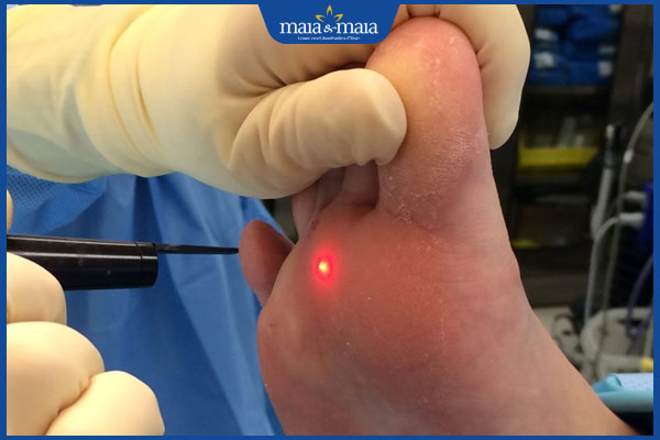 laser đốt mụn ké